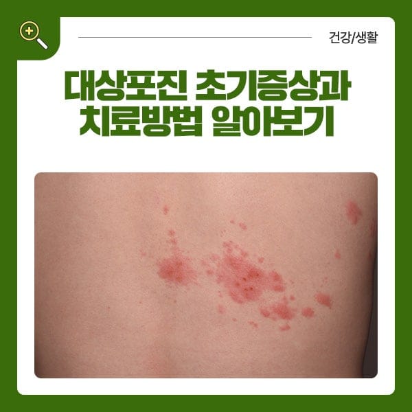대상포진 예방접종