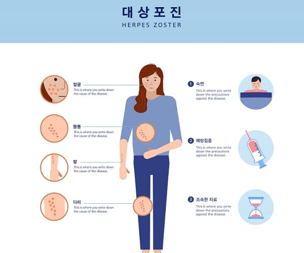 대상포진 예방접종